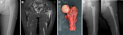 The outcomes of proximal femur replacement with hemiarthroplasty after tumor resection in individuals with Parkinson's disease